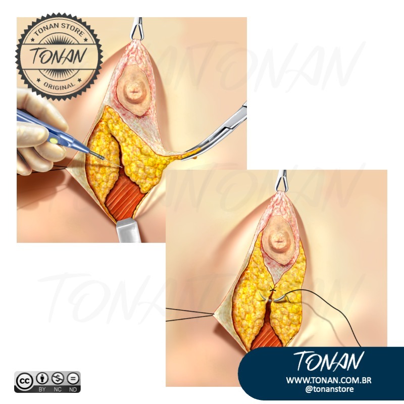 Tonan Ilustracaomedica10 Yle4zkKRMECql7BZ