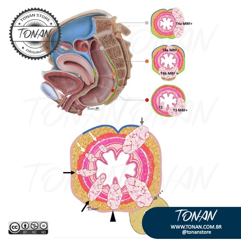 Tonan Ilustracaomedica30 Yg24gkKzzPsM5Mwb