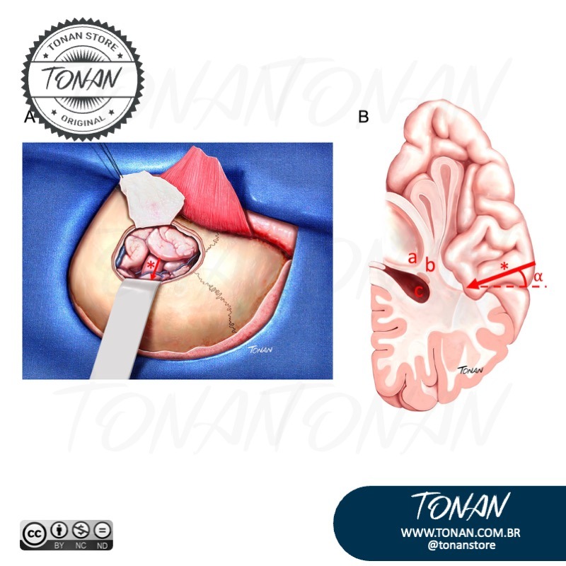 Tonan Ilustracaomedica32 Y4LP36X1QaHQBMBO