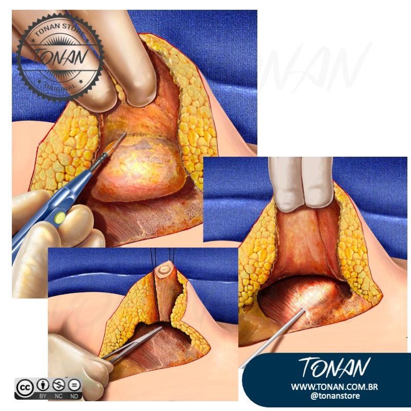 Tonan Ilustracaomedica44 Aq2GzyK94OUb05XG