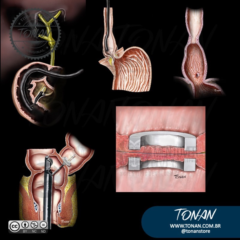 Tonan Ilustracaomedica46 ALp2DwgK92fzwvKy
